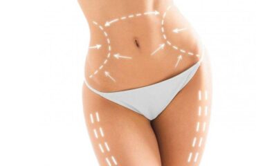 lipoescultura-laser
