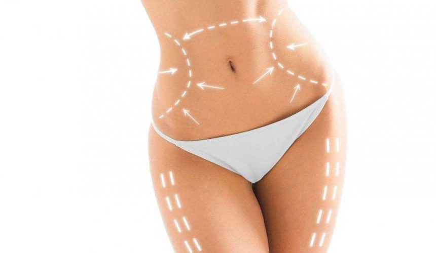 Lipoescultura Láser