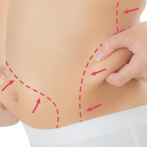 Lipoescultura Lipoescultura