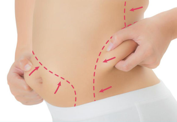 Lipoescultura