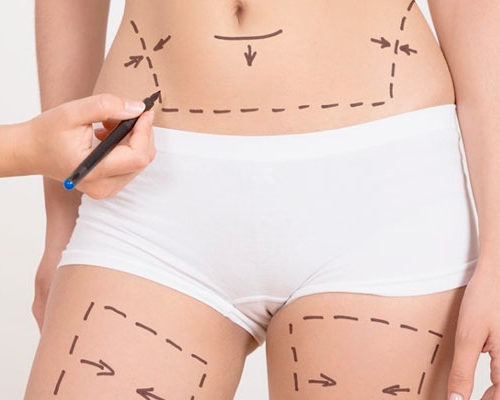 Lipoescultura Laser mínimamente invasiva