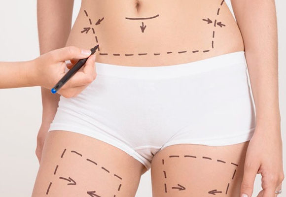 Lipoescultura Laser mínimamente invasiva Lipoescultura Laser mínimamente invasiva