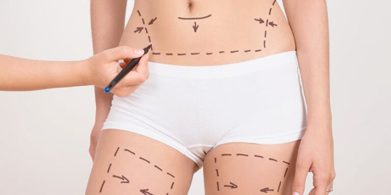 Lipoescultura Laser mínimamente invasiva